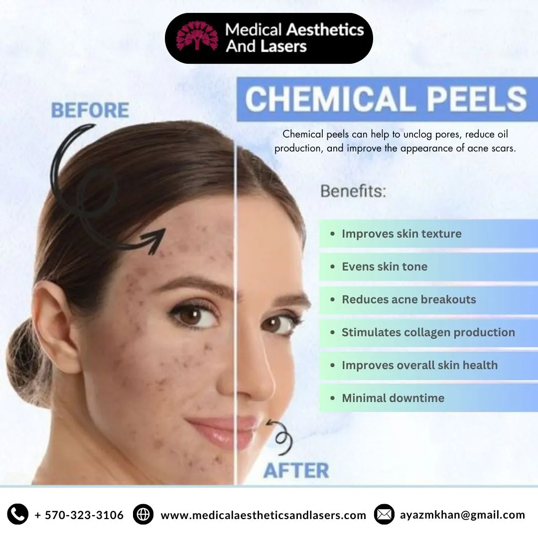 Chemical Face Peel Near Williamsport, PA | Expert Skincare